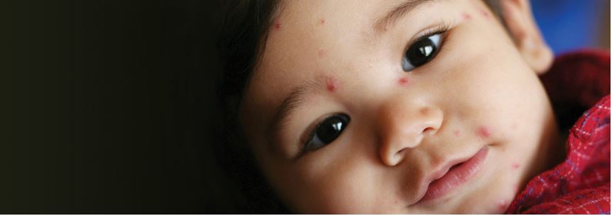 Chickenpox